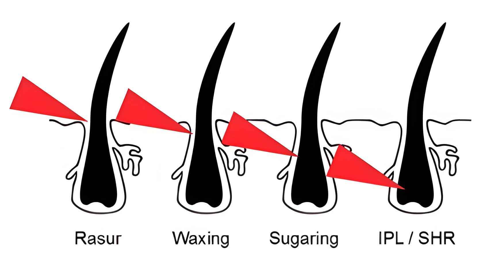 Vergleich der Wirksamkeit unterschiedlicher Haarentfernungsmethoden: Rasur, Waxing, Sugaring und IPL/SHR